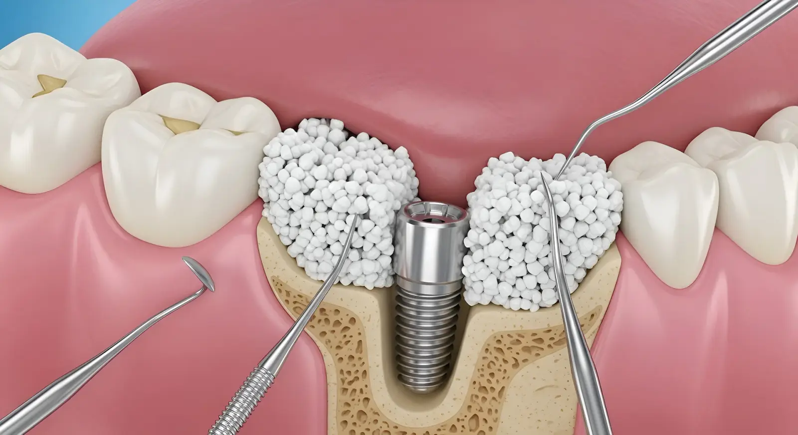 Gum grafting procedure restoring receding gum tissue