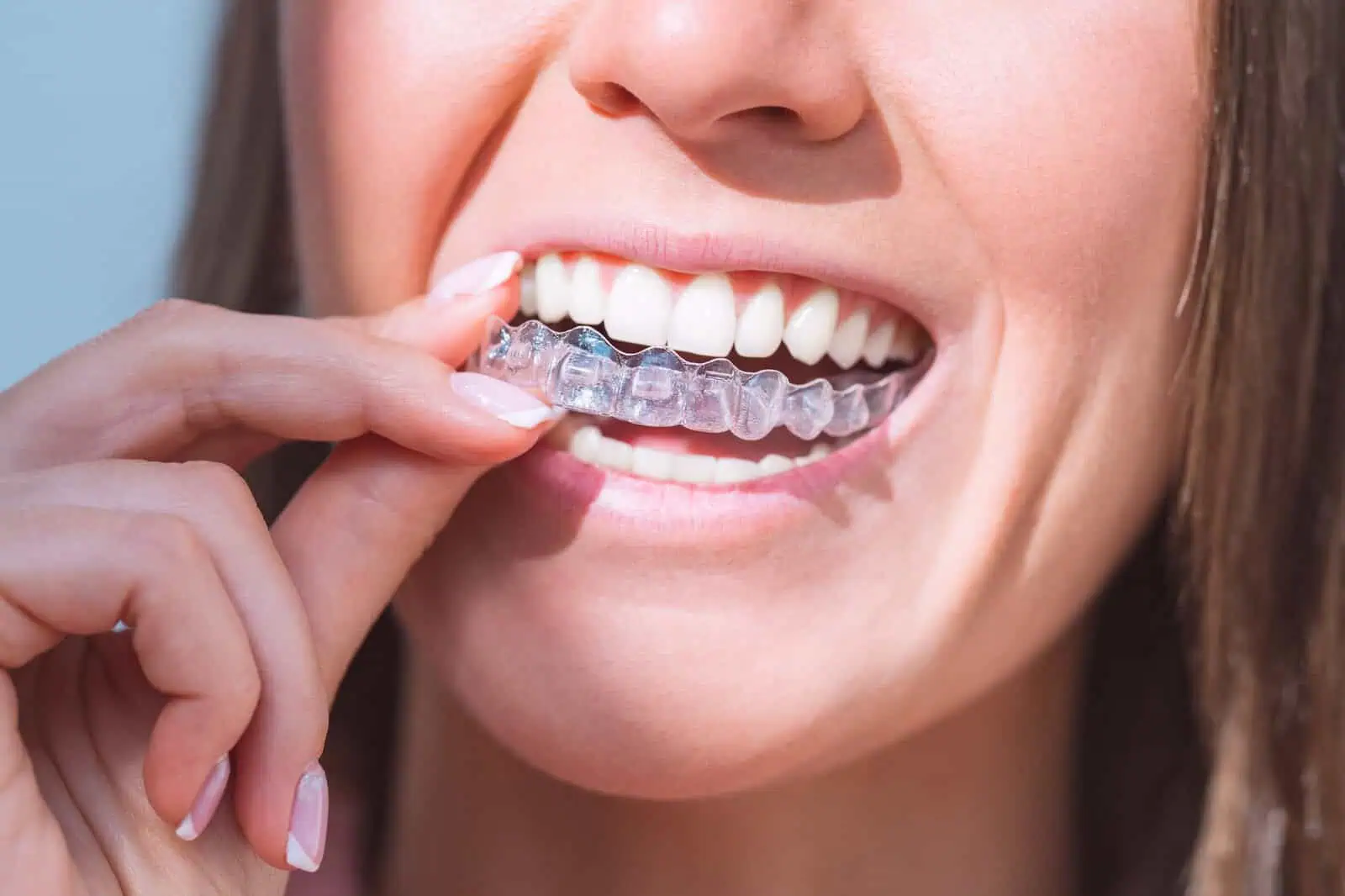 Invisalign clear aligners at Riverwalk Dental Group