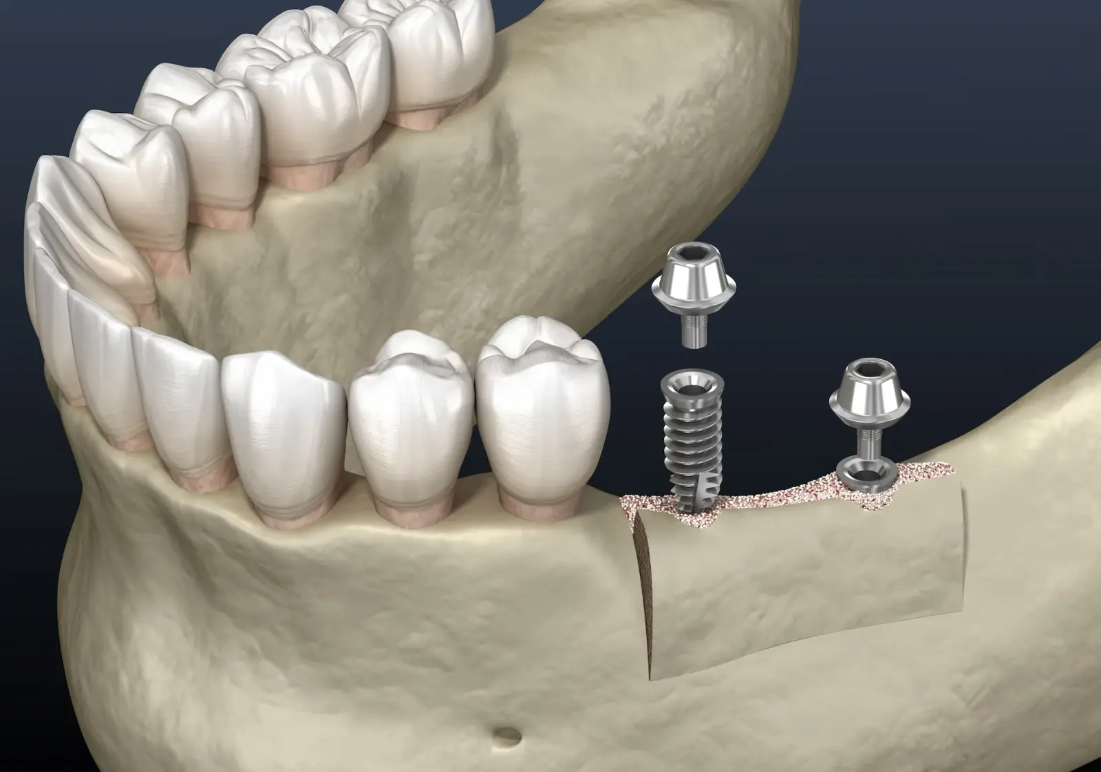 Ridge augmentation rebuilding jaw ridge for dental implant