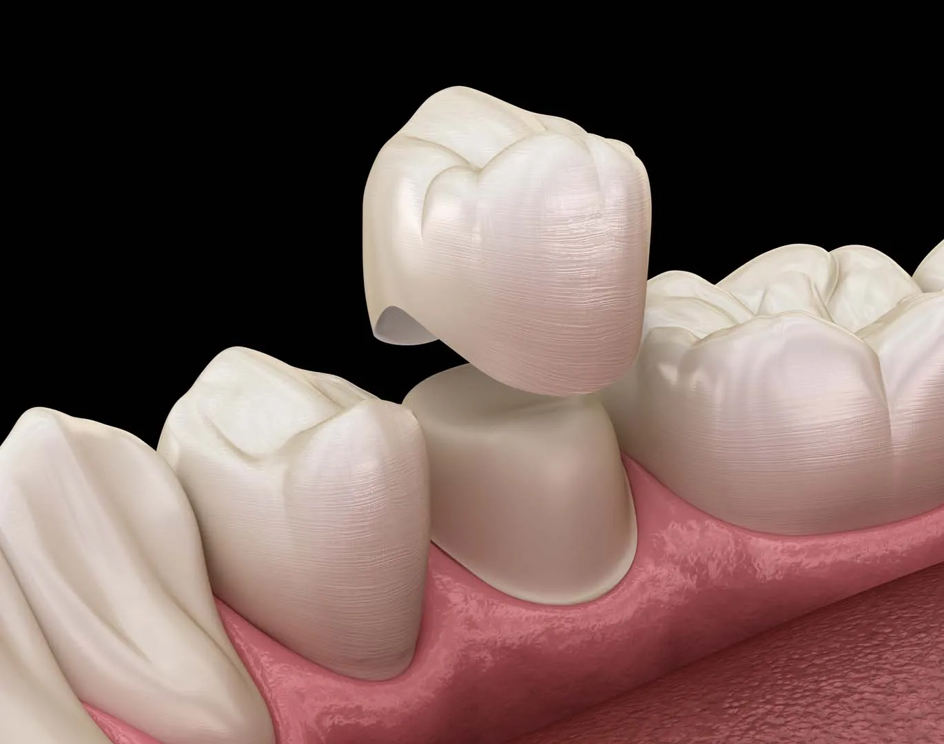 Ceramic dental crown restoration