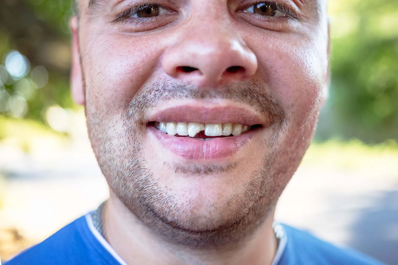 Tooth-coloured dental restoration treatment