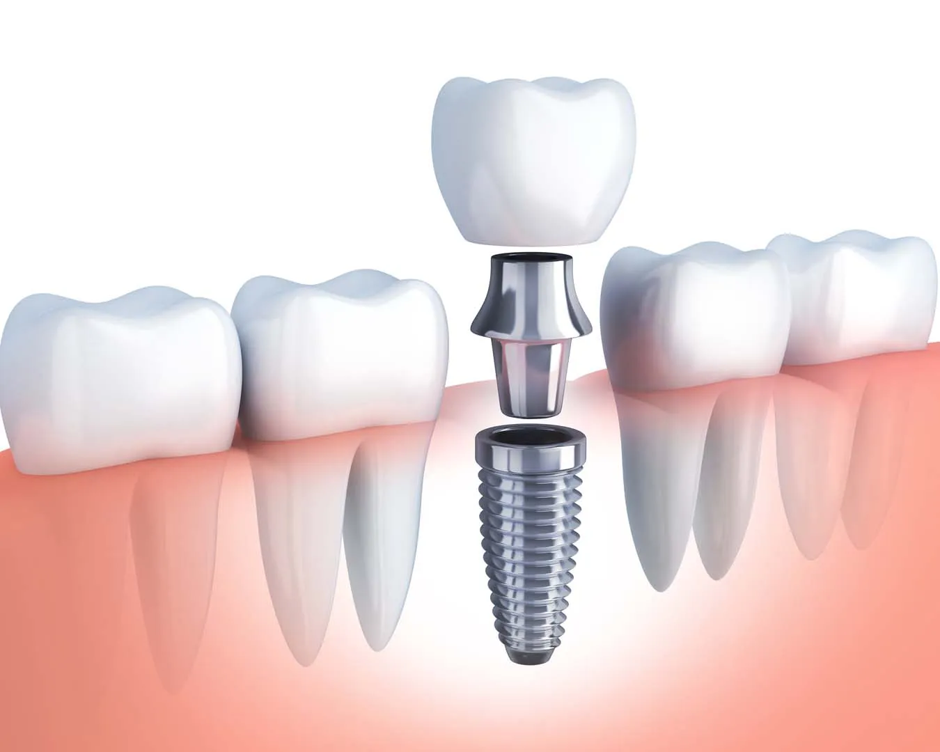 Computer-guided dental implant planning at Riverwalk Dental Group