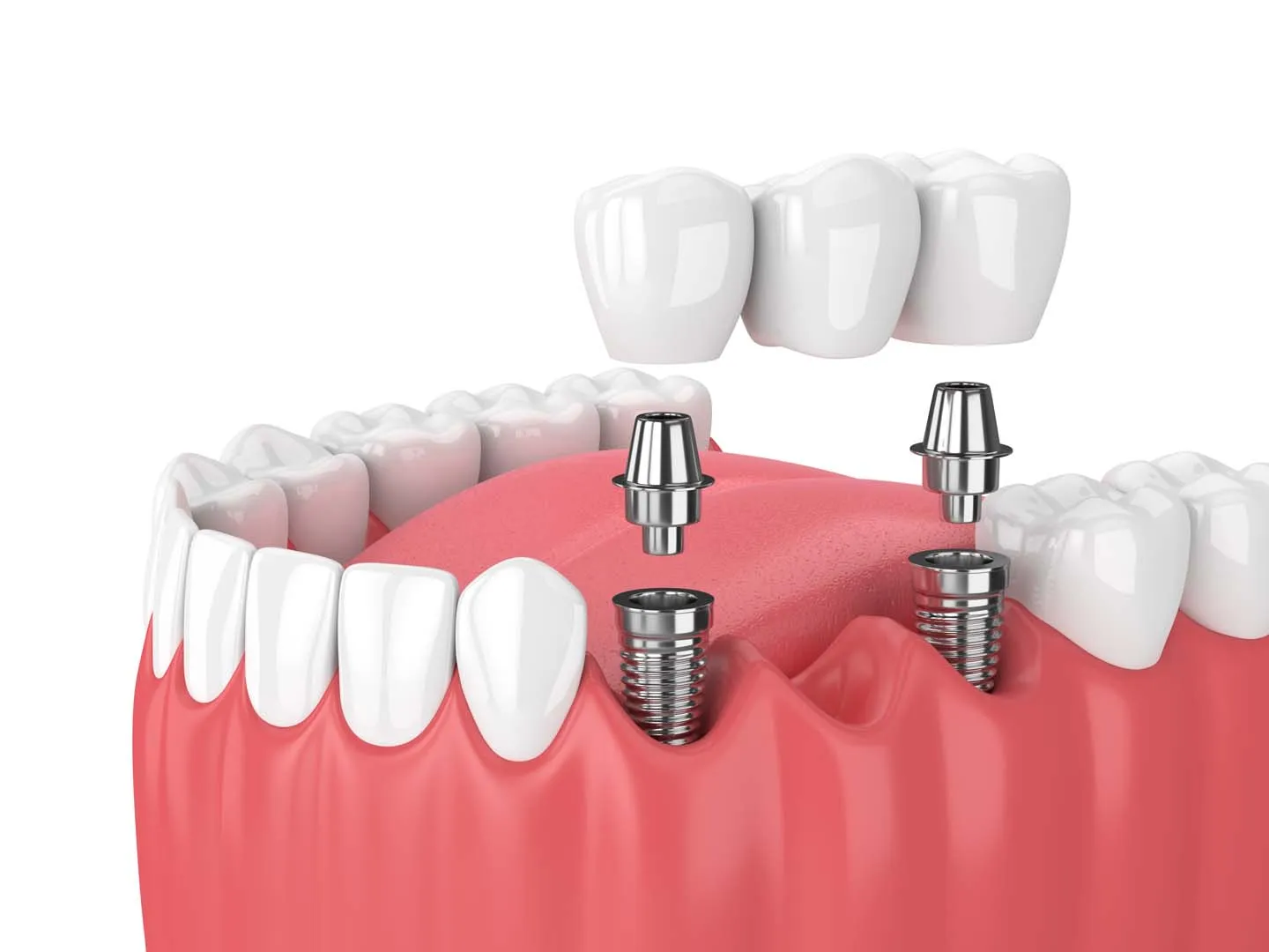 Dental implant planning and placement