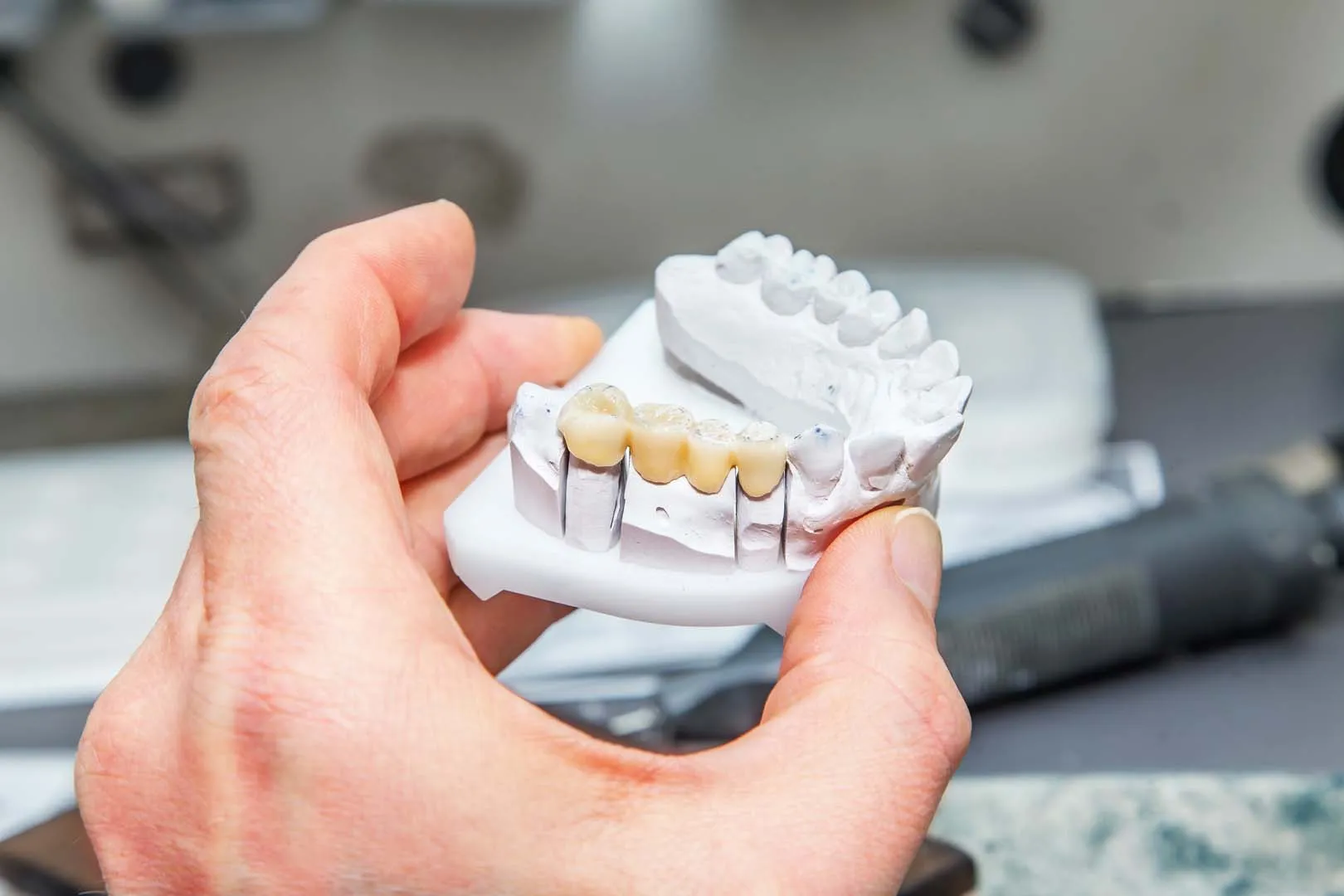 Dental bridge replacing a missing tooth